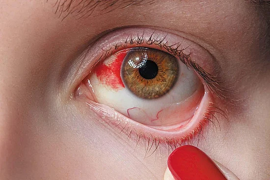 Bleed Inside Eye