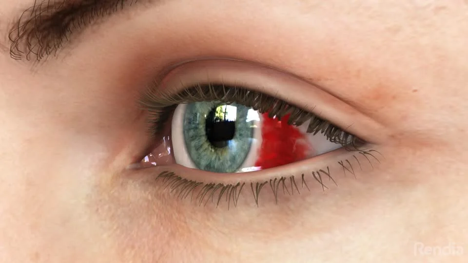 Bleed Inside Eye