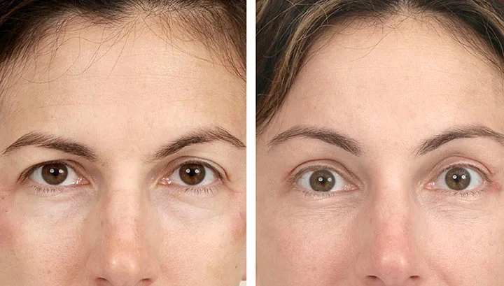 Endoscopic brow lift before after