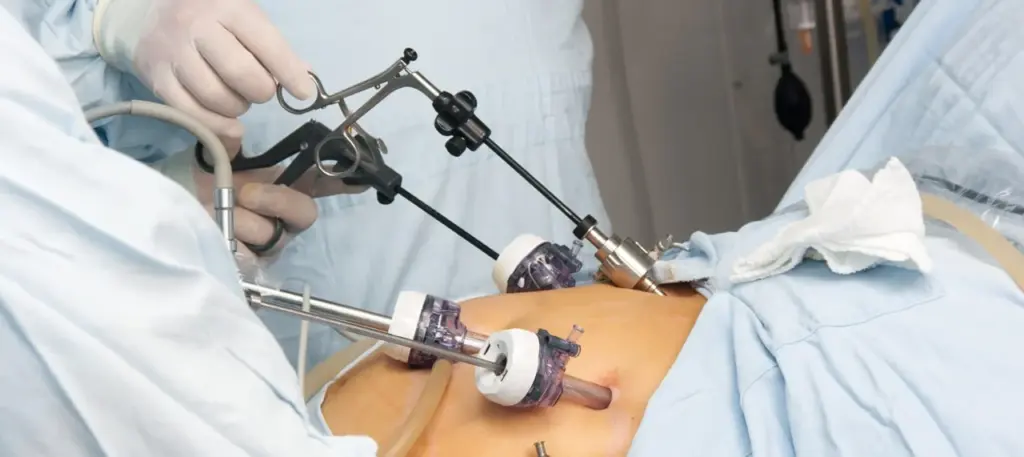What Is Gastric Sleeve Revision Surgery? Why Is It Performed? 1 Gastric Sleeve Revision Surgery