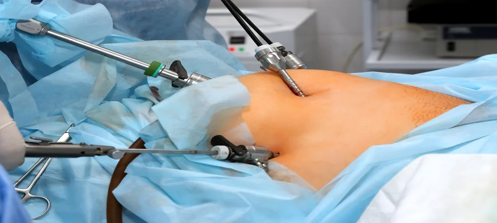 Kilo Verme Ameliyatı Fiyatı ve Başarı Oranı 2 How is weight loss surgery performed