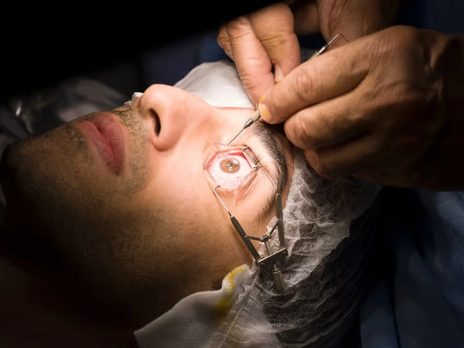 LASIK eye surgery
