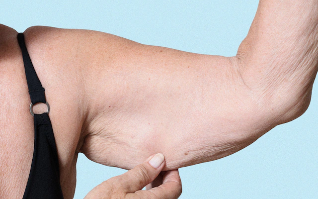 Loose Skin After Weight Loss