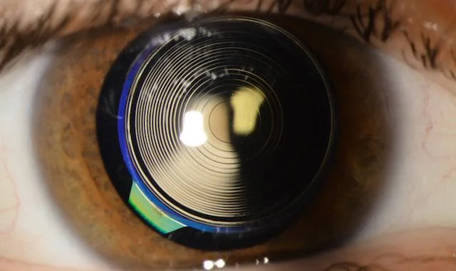 Was ist eine multifokale IOL? Was ist ihr Zweck? 1 Multifocal IOL