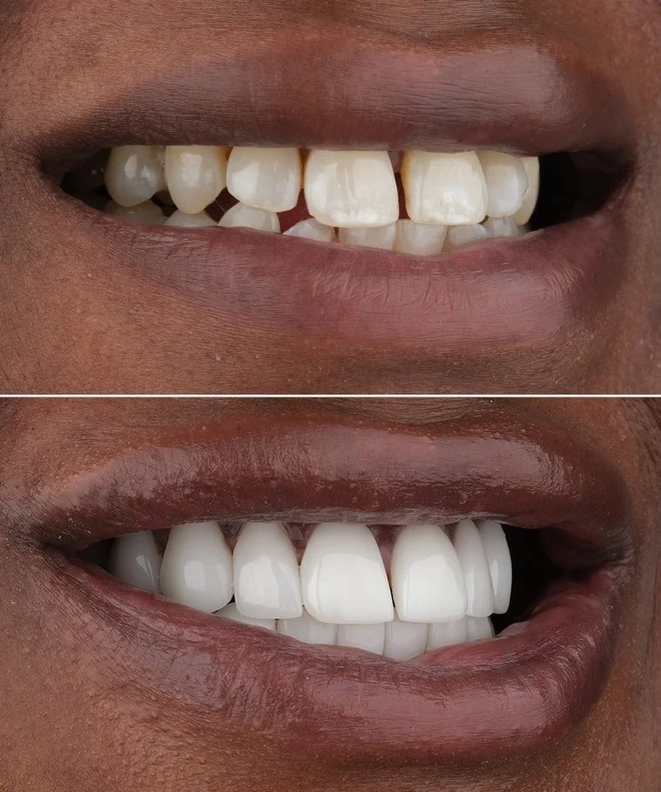Was sind No-Prep-Veneers? Ablauf, Kosten und Komplettpakete in der Türkei 3 No prep veneers