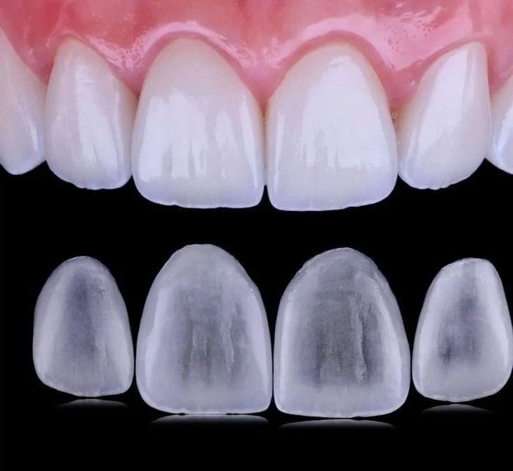Was sind No-Prep-Veneers? Ablauf, Kosten und Komplettpakete in der Türkei 2 No prep veneers