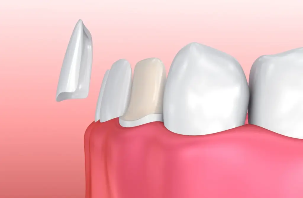 How Are Porcelain Coatings Made? What Are Their Advantages? 1 Porcelain veneers