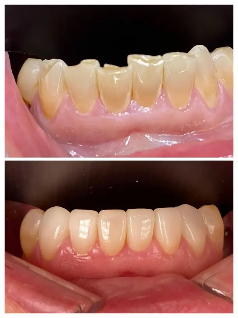 How Are Porcelain Coatings Made? What Are Their Advantages? 2 Porcelain veneers before after
