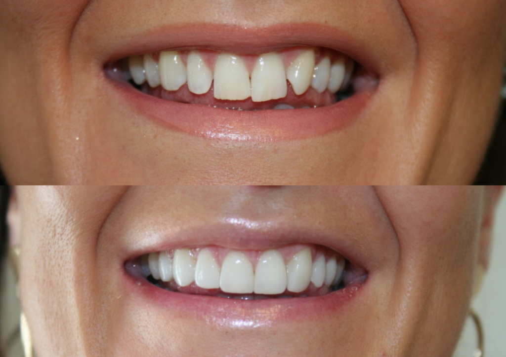 How Are Porcelain Coatings Made? What Are Their Advantages? 3 Porcelain veneers cost