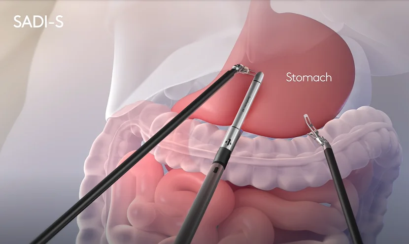 SADI-S Surgery