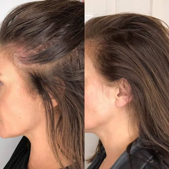 Saç Derisi Mikropigmentasyonu Nedir? Maliyetler, İyileşme Süreci ve Tedavi Sonuçları 2 Scalp micropigmentation