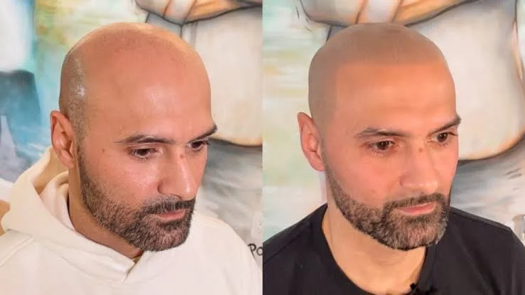 Saç Derisi Mikropigmentasyonu Nedir? Maliyetler, İyileşme Süreci ve Tedavi Sonuçları 3 Scalp micropigmentation