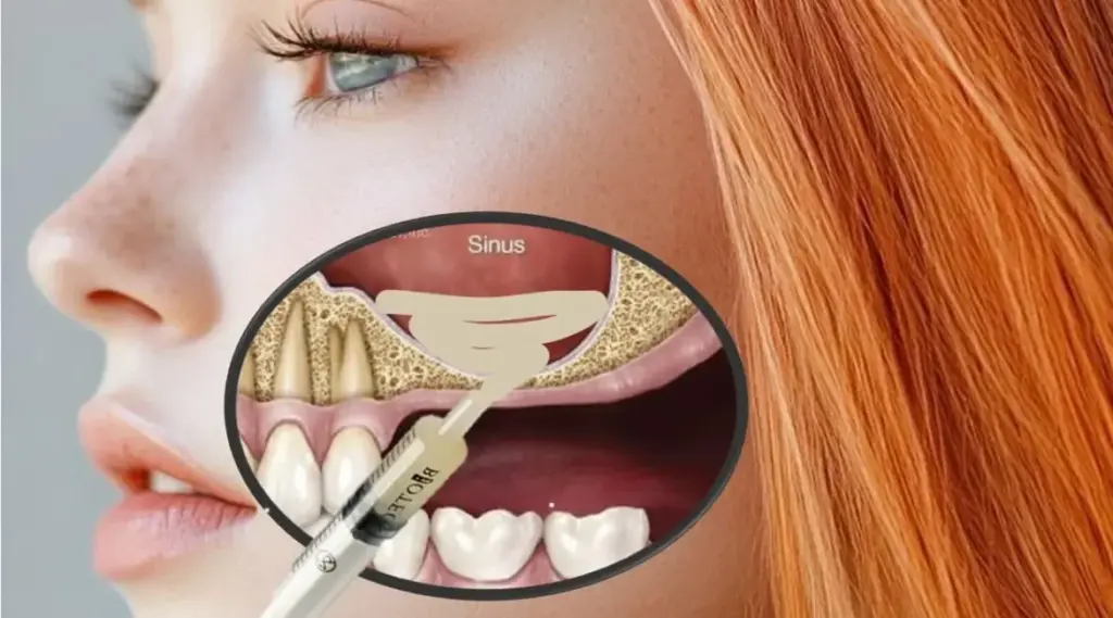 Sinus Lift