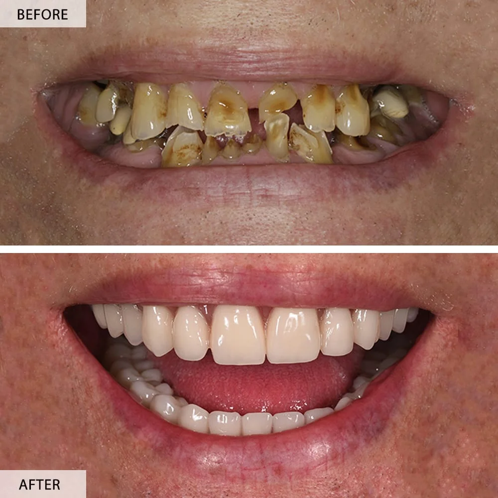 all on 4 dental implant before after