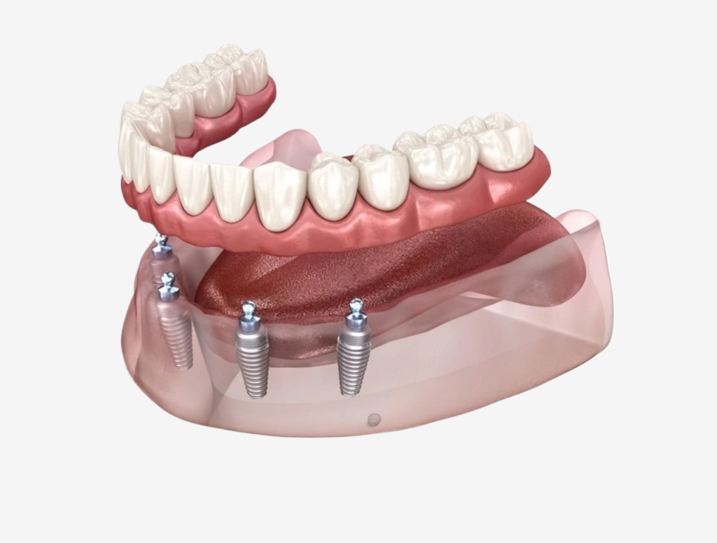 all on 4 dis implanti uygulama sureci