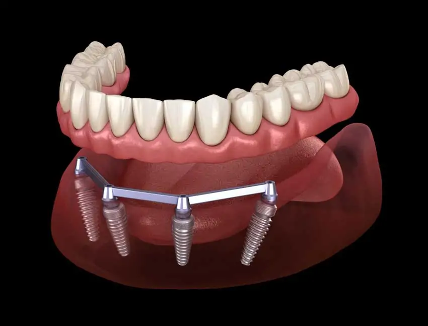 all-on-four dental implant