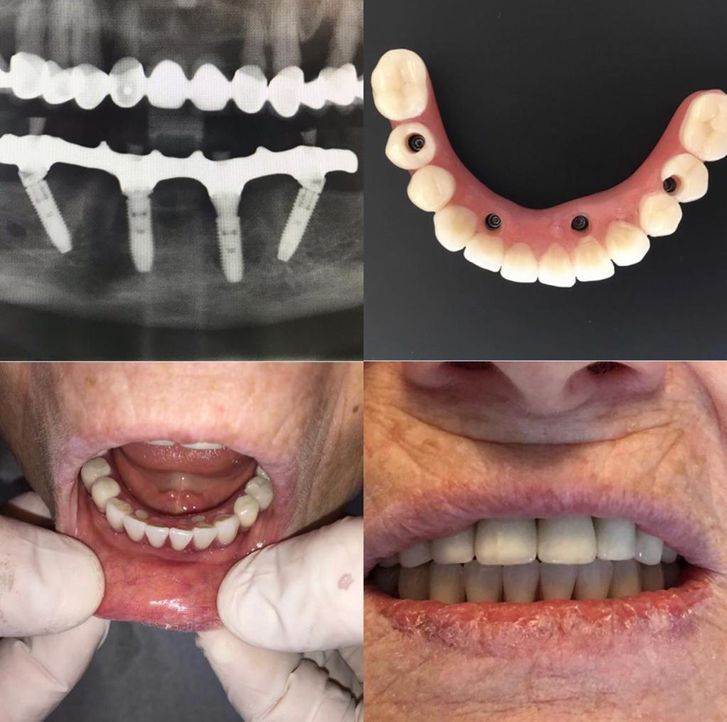 all on four techniques