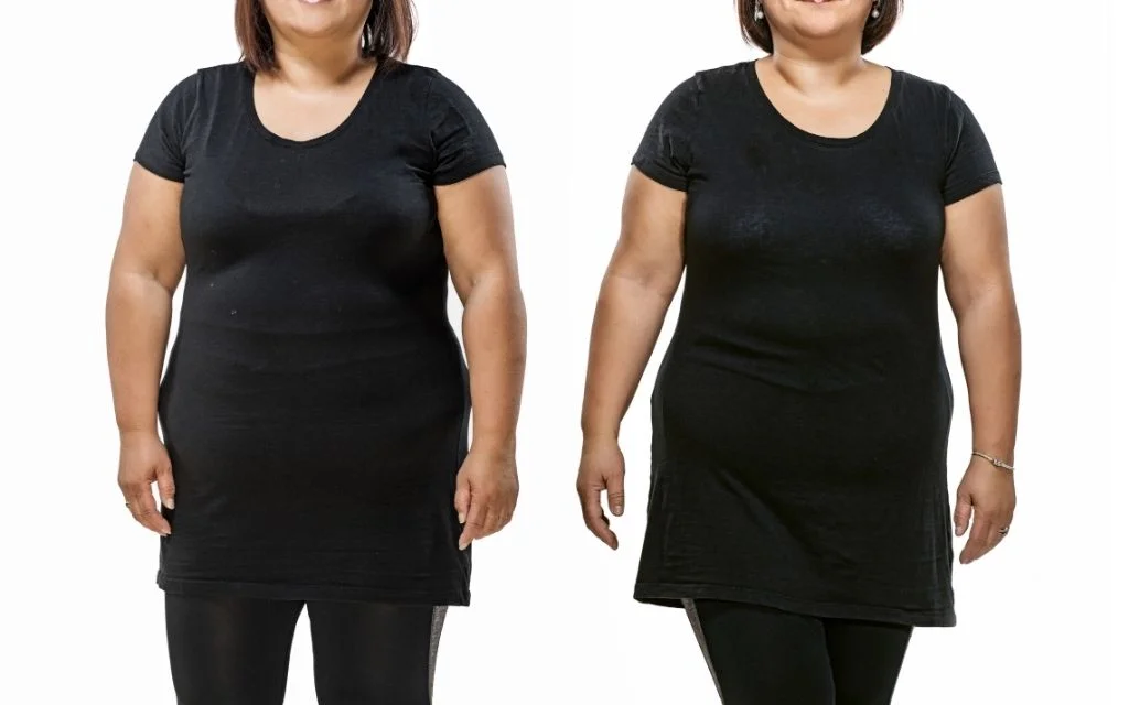 bariatric revision surgery before after