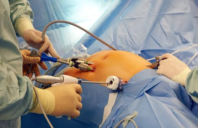bariatric revision surgery