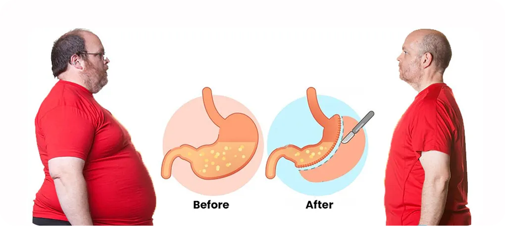 bariatric surgery before after