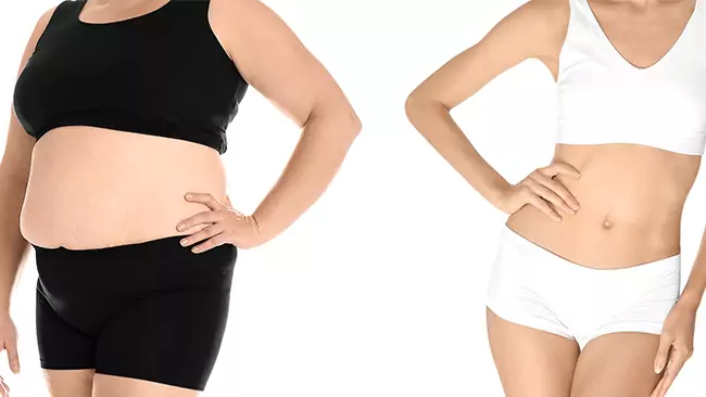 bariatric surgery recovery