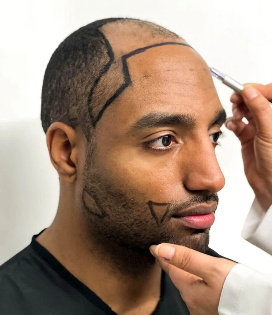 beard to scalp hair transplant cost