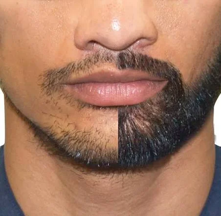 beard to scalp hair transplant