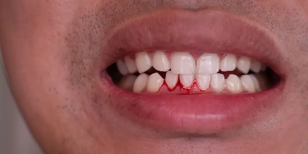 Zahnfleischbluten Ursachen, Behandlung & Was wirklich hilft 1 bleeding gums