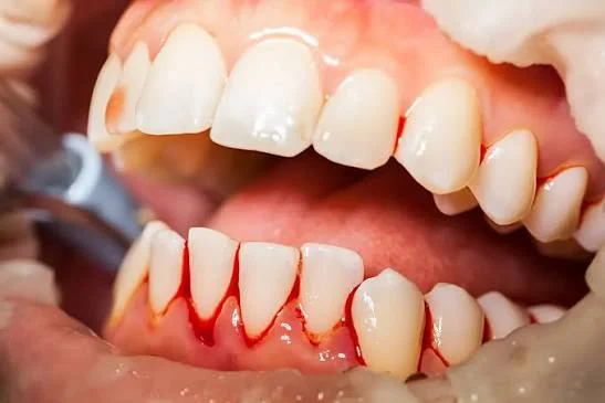 Zahnfleischbluten Ursachen, Behandlung & Was wirklich hilft 2 bleeding gums