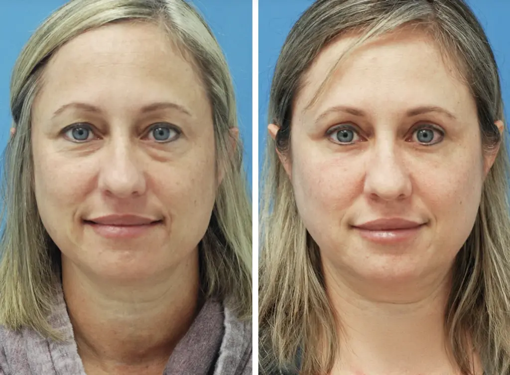 Blepharoplastik Methoden, Kosten in der Türkei & Heilung 2 blepharoplasty