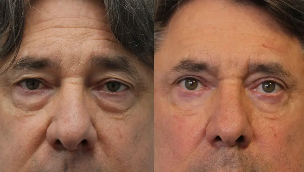 Blepharoplastik Methoden, Kosten in der Türkei & Heilung 3 blepharoplasty before and after