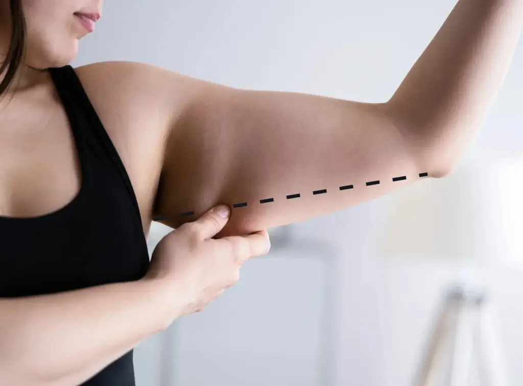 Armlift Operatie: Littekens, Kosten, Herstel en Turkije Gids 1 brachioplasty