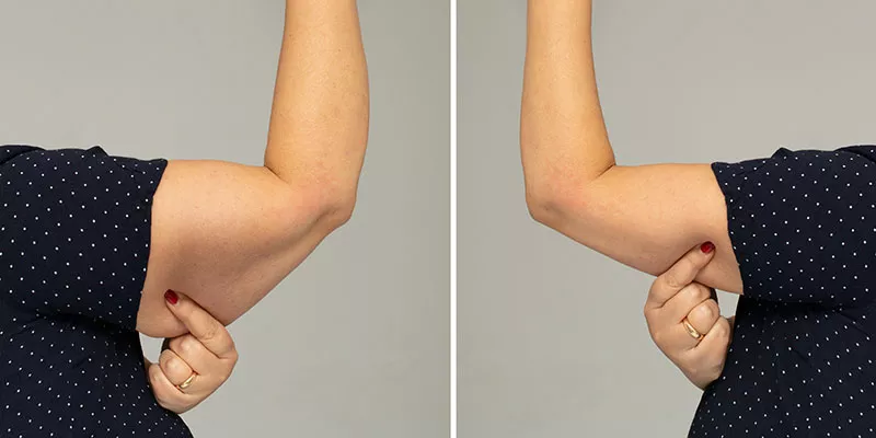 Armlift Operatie: Littekens, Kosten, Herstel en Turkije Gids 3 brachioplasty before after