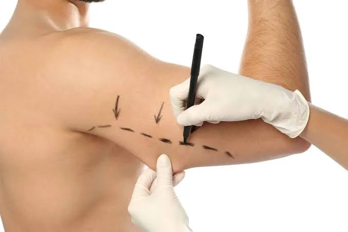 Armlift Operatie: Littekens, Kosten, Herstel en Turkije Gids 2 brachioplasty surgery