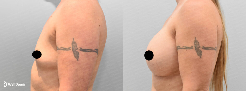 breast augmentation