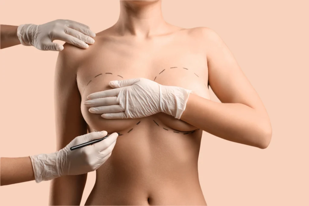 breast augmentation