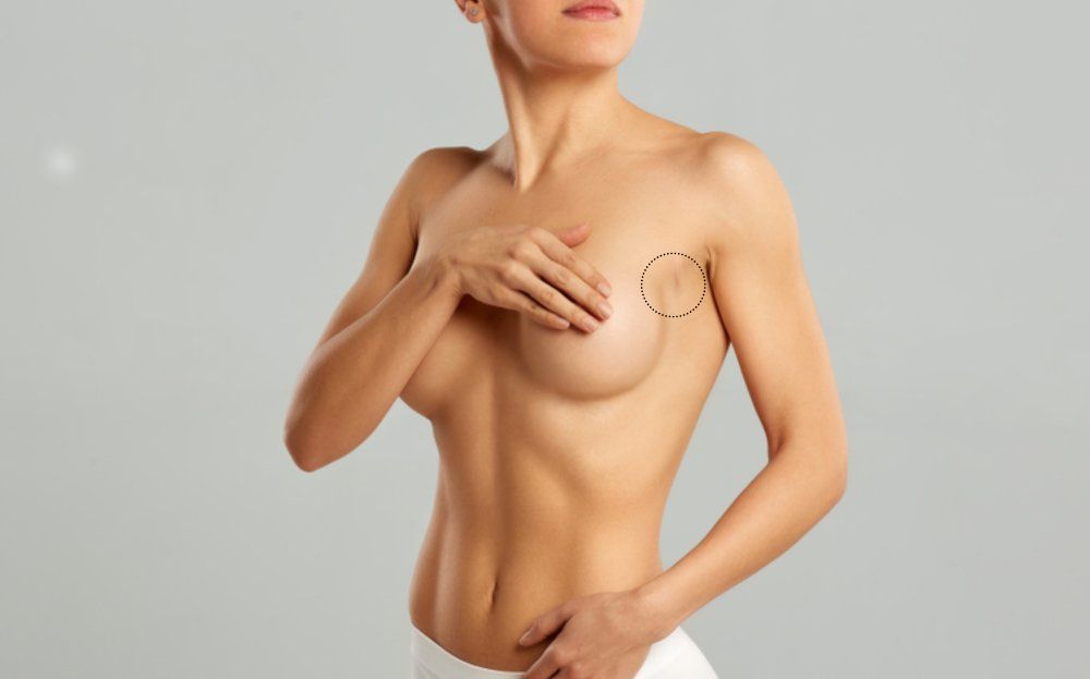 breast augmentation surgery
