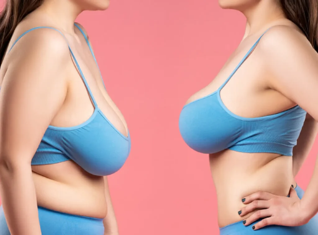 breast lift and breast augmentation