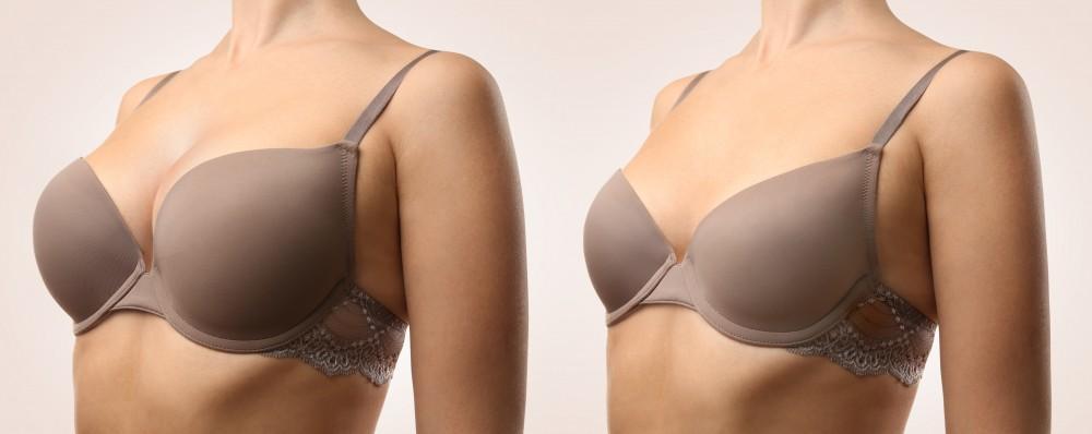 breast lift vs breast augmentation chooese your option
