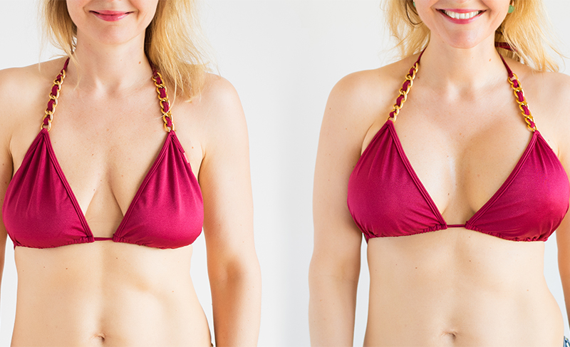breast lift vs breast augmentation