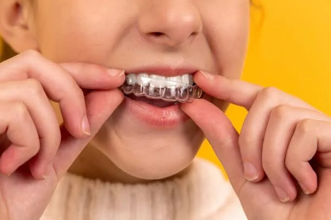 Bruxism Symptoms, Causes, Mouth Guards & Botox 2 bruxism guard