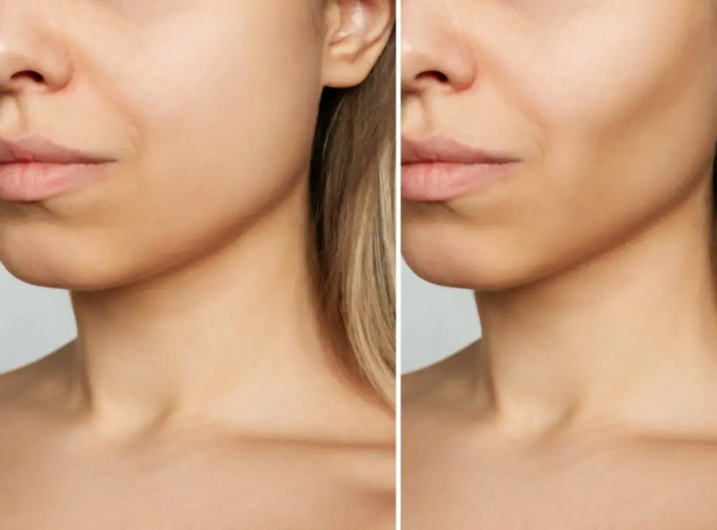 buccal fat removal