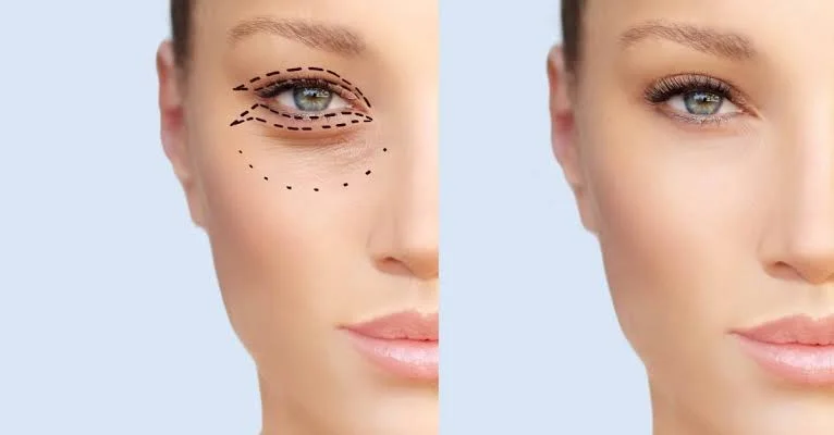 canthoplasty before after
