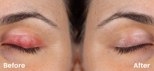 Operation am Hagelkorn: Ablauf, Schmerzen, Heilung & Kosten 3 chalazion surgery before after
