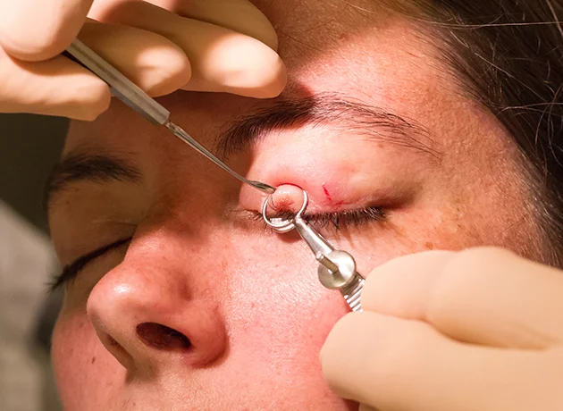 Operation am Hagelkorn: Ablauf, Schmerzen, Heilung & Kosten 2 chalazion surgery