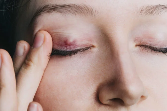 Operation am Hagelkorn: Ablauf, Schmerzen, Heilung & Kosten 1 chalazion surgery