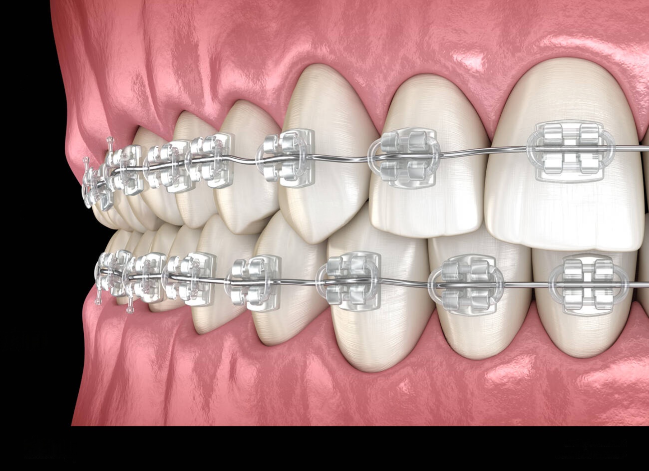 What is a Brace? What are its Types?