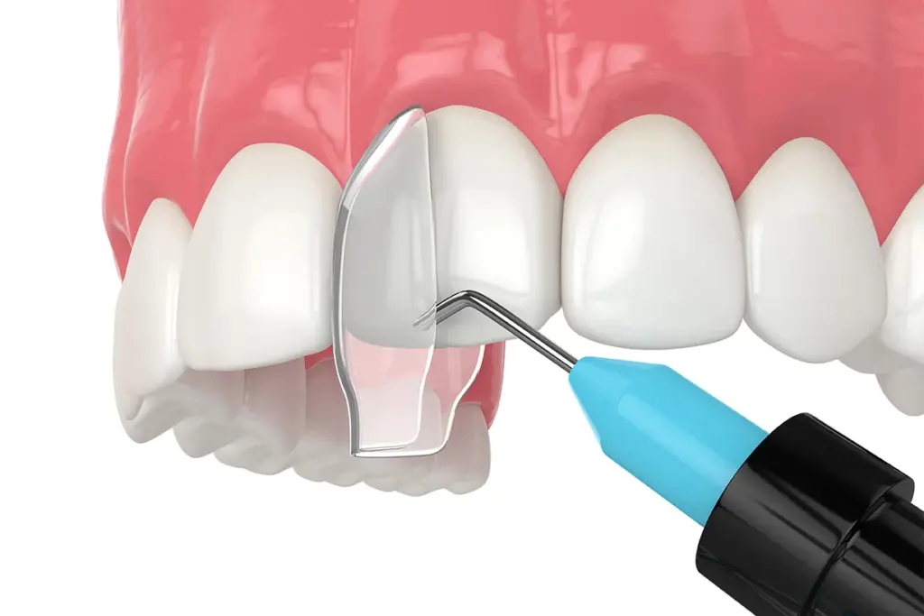 composite bonding 1