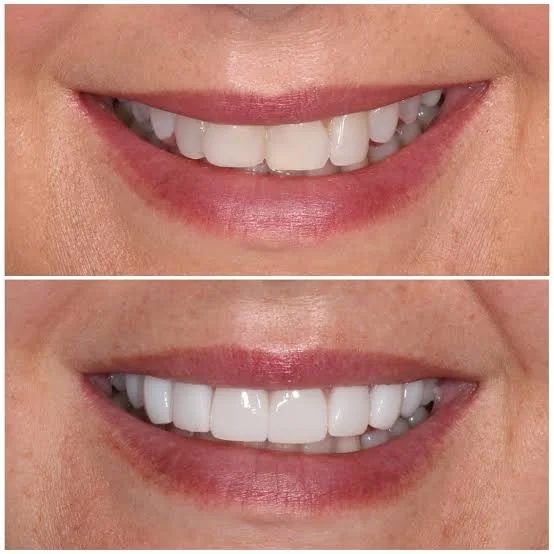 Composite Bonding Teeth Guide: Cost Factors, Longevity, and Results 2 composite bonding