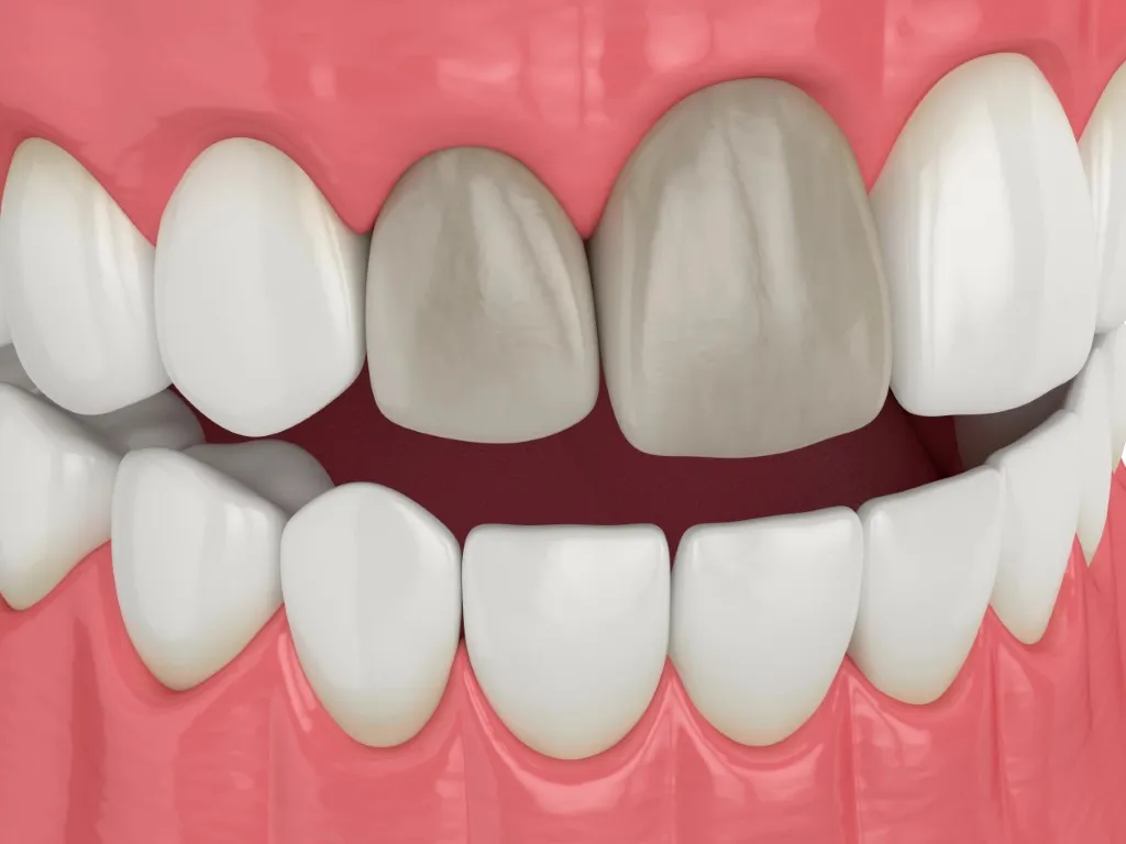 How to Save a Dead Tooth: Causes, Symptoms, and Prevention 1 dead teeth
